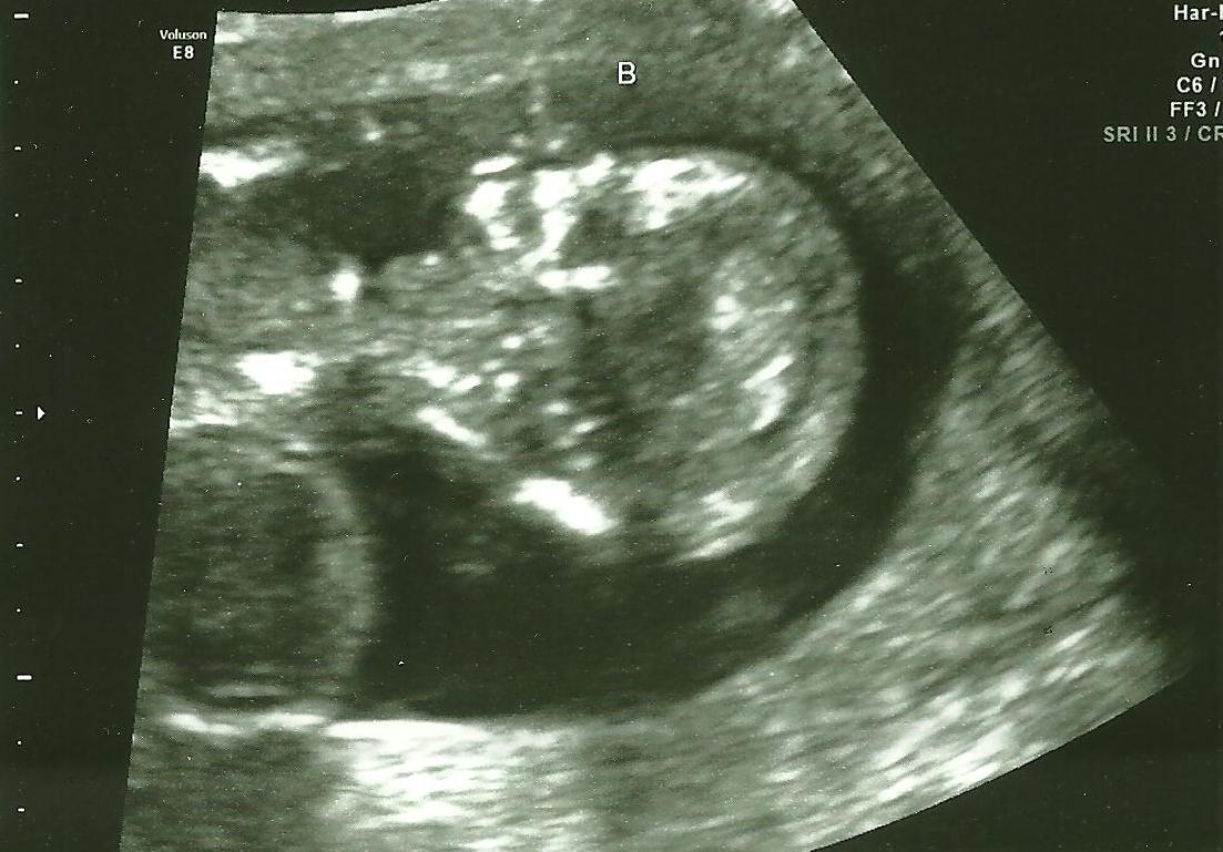 2 New Rubys 14 week ultrasound pictures