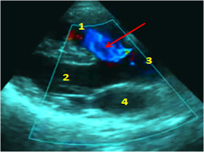 Tetralogy of Fallot echocardiogram-color flow cardiology book