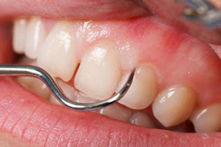 Thế nào là Quy trình lấy cao răng siêu âm chuẩn?