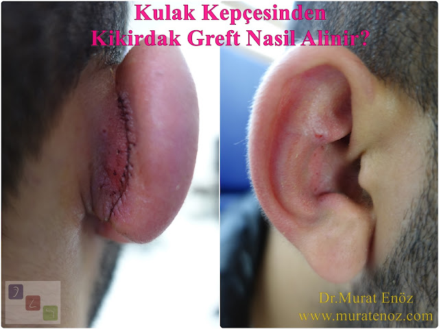 Auricular Cartilage (Auricular Cartilage) Graft in Revision Rhinoplasty - Why auricle cartilage graft is needed in revision rhinoplasty operations? - When auricle cartilage graft is used in revision nose job surgeries? - How to taken the cartilage graft from the auricle (auricular conchal cartilage)? - Recommendations after the cartilage graft taken from the auricle  - Does the shape of the auricle change after the cartilage graft taken from the auricle? - Why is a cartilage graft removed from the auricle? - In which cases is the cartilage graft used from the auricle? - Use of cartilage graft taken from the ear for revision nose aesthetic - Cartilage graft taken from the auricle - What to do after taken of the cartilage graft from the auricle? - Auriculer conchal cartilage - Use of auricular conchal cartilage in nose aesthetic surgery