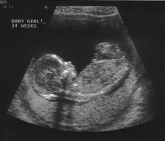 14 недель отзывы. УЗИ 15 недель беременности. УЗИ 14 недель беременности. УЗИ 15 недель беременности фото. Снимок УЗИ 15 недель беременности.