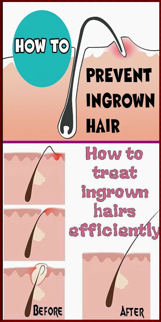 How to Properly Remove Ingrown Hair ? note in beauty