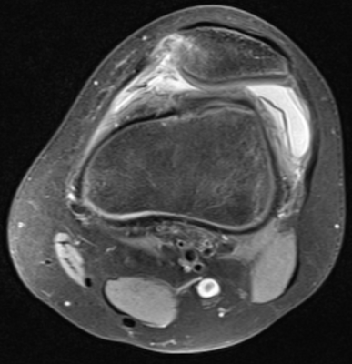 Transient patellar dislocation