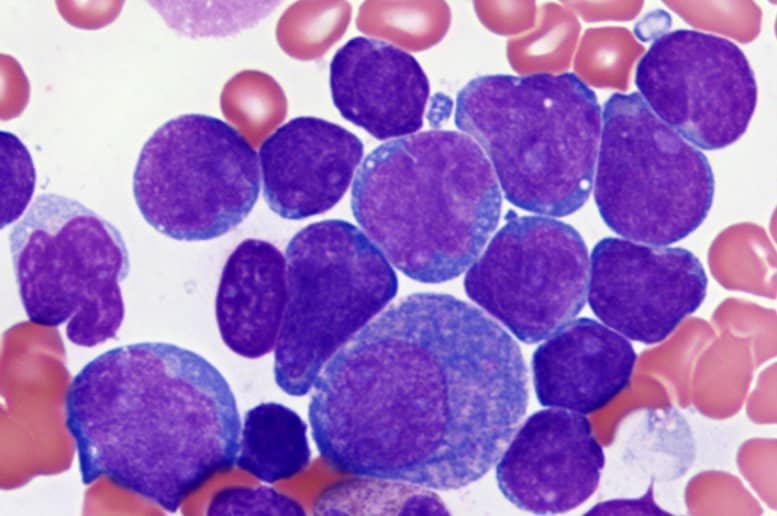 Acute Lymphoblastic Leukemia In Adults Survival Rate