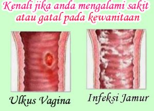 8 penyebab gatal pada lubang vagina dan cara mengatasinya 8 penyebab gatal pada lubang vagina dan cara mengatasinya