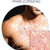 Hives Treatment ( Hives Home Remedies )