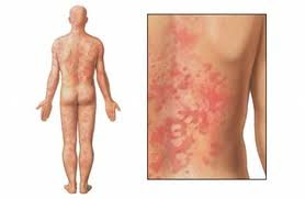 Tratamiento urticaria