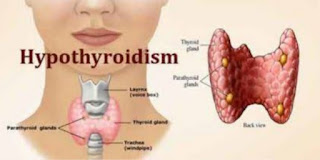 TREATMENT OF THYROID