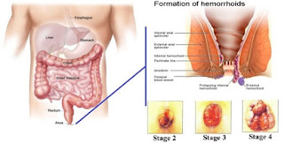 obat herbal untuk ambeien