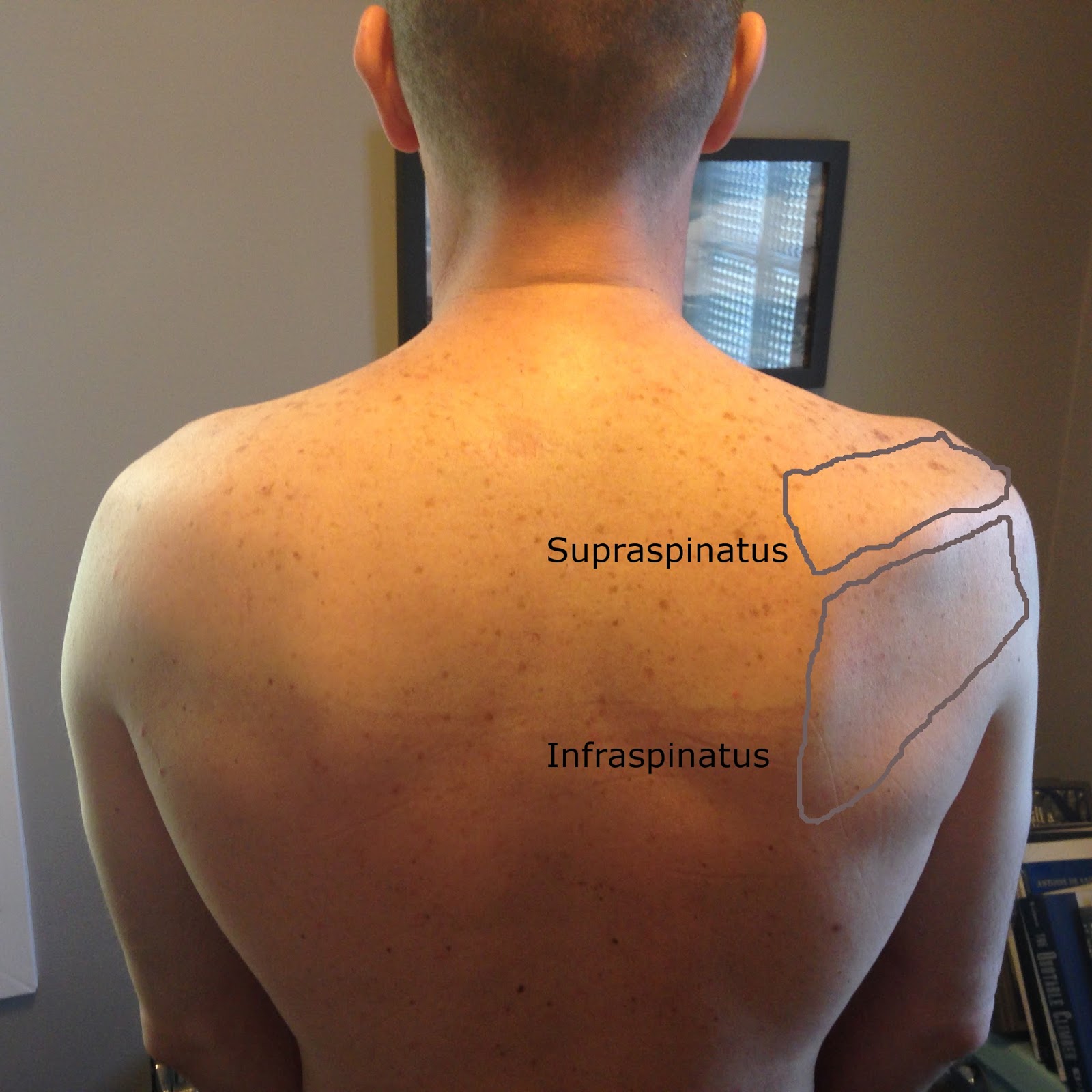 broken-wing-28-days-post-surgery-a-tale-of-atrophy