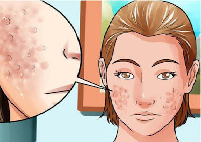 How To Get Rid Of Acne Free How To Get Rid Of Acne Free