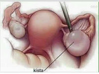 Atasi OLIGOMENORE (KETIDAKTERATURAN HAID) dgn Air MILAGROS Atasi OLIGOMENORE (KETIDAKTERATURAN HAID) dgn Air MILAGROS