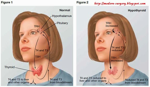 Modern Surgery Hypothyroidism