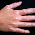 Tratamentos diminuem manchas provocadas pelo vitiligo