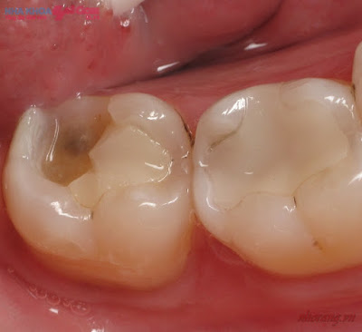Nhiễm khuẩn sau khi nhổ răng