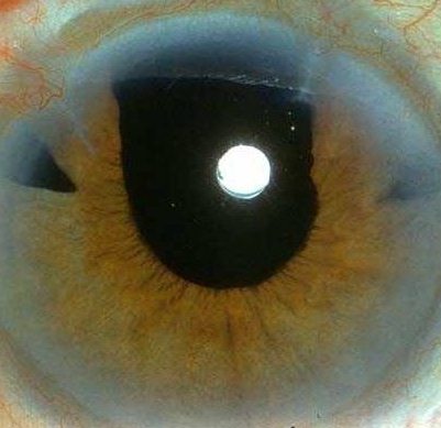 Cataract research paper