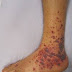 Autoimmune and Inflammation: A Brief Overview
