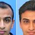 6 Cheap Hair Loss Treatments