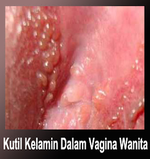 Kutil Kelamin Wanita (Vagina Dalam) Obat Kutil Mengobati Kutil, Mengatasi Kutil, Menyembuhkan Kutil, Menghilangkan Kutil, Penghilang Kutil, Penghapus Kutil, Perontok Kutil, Obat Kutil Kelamin, Cara & Tips Menghilangkan Kutil 1 Malam Hilang, Menghilangkan Kutil Kelamin Dari Rumah Sendiri Jangka 3 Hari, Obat Kutil Manjur, Obat Kutil Kelamin Pria, Obat Kutil Kelamin Wanita, Obat Kutil Kelamin Untuk Zakar / Ubat Ketuat Di Kemaluan Kelamin Penis Pria, Obat Kutil Kelamin Laki-Laki, Obat Kutil Kelamin Perempuan, Obat Kutil Kelamin Ibu Hamil (Menyusui / Mengandung), Obat Kutil Herbal, Obat Kutil Mujarab, Obat Kutil Alami, Obat Kutil Di Apotek, Obat Kutil Di Dubur / Anus, Obat Kutil Di Paha, Obat Kutil Di Apotik, Obat Kutil Di Dalam / Luar Vagina, Obat Kutil Di Badan Lainnya, Obat Kutil Kelamin Anak-Anak, Krim Kutil, Obat Kutil Ampuh, Obat Kutil Kelamin Tanpa Operasi Terbukti Keampuhannya, Cream Kutil, Salep Untuk Kutil, Obat Oles Buat Kutil, Obat Penghilang Kutil Pada Kulit Yang Terbukti Aman Tanpa Efek Samping Serta Terpercaya