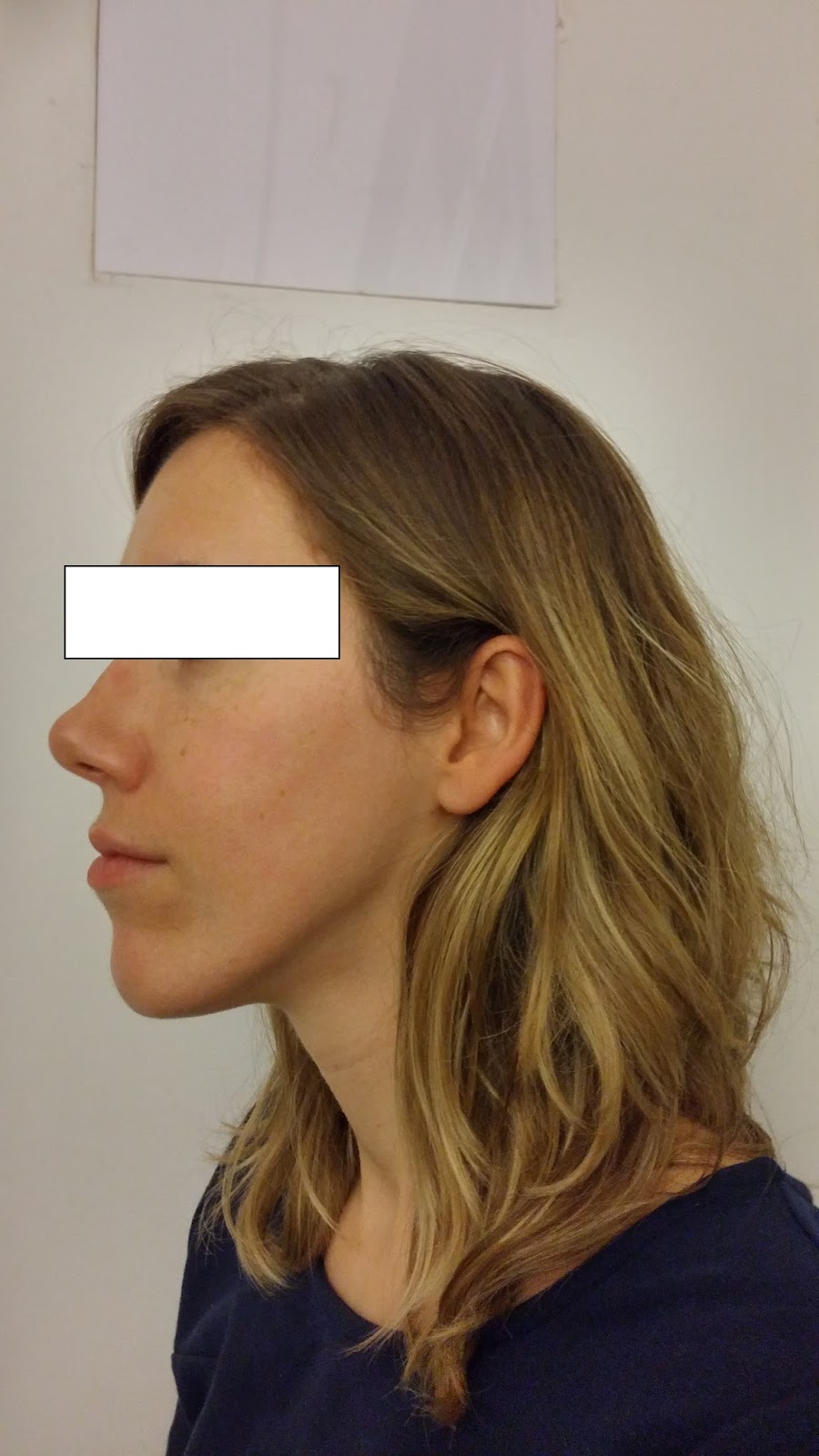 Chirurgie maxillofaciale ostéotomie bimaxillaire et génioplastie S +7 et avant après