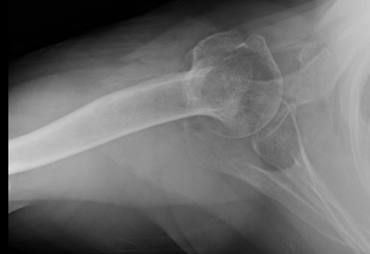 Shoulder and Elbow Surgery Non operative treatment of the fracture of