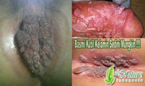 kutil kelamin kutil kelamin