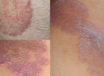 Image OBAT HERBAL UNTUK GATAL GATAL DI SELA PAHA MANJUR