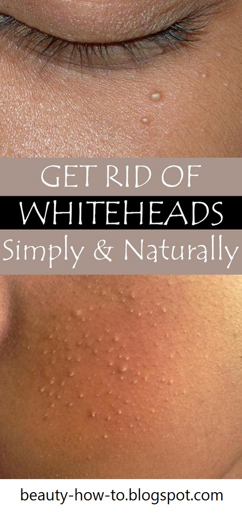 8 Ways To Get Rid Of Whiteheads At Home How To Beauty