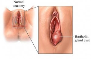 Hard Bump On Vagina 85