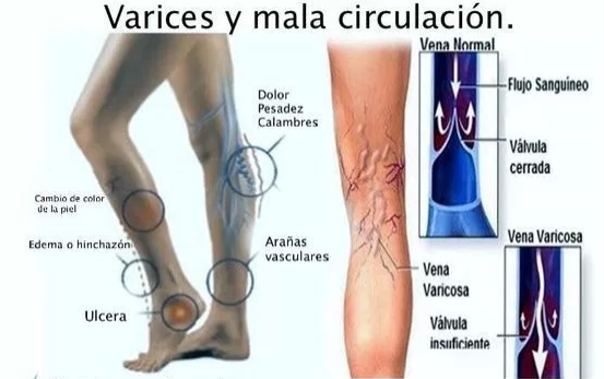 Mala que tengo circulacion hago sanguinea