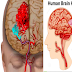 Brain Aneurysm: 8 Causes That Can Highly Upsurge Aneurysm