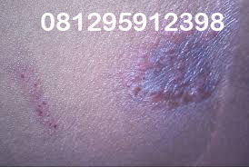 Obat kadas paling ampuh ~ obat kutil kelamin