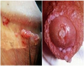 Kumpulan Obat Kutil Di Wajah