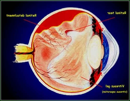 Ciri Tanda Ablasio Retina - Penyebab Gejala dan Cara Penggobatan Paling Ampuh Ciri Tanda Ablasio Retina - Penyebab Gejala dan Cara Penggobatan Paling Ampuh