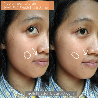 nacific fresh herb serum for acne