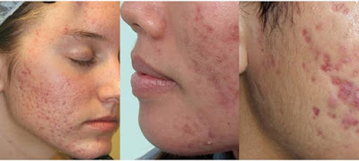 Thâm mụn và cách điều trị an toàn, hiệu quả
