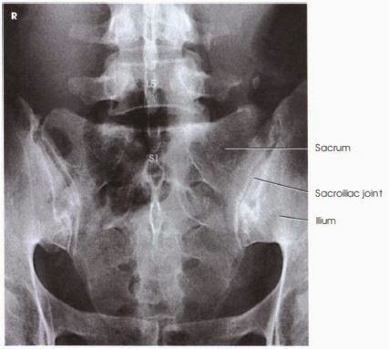 Lumbar X ray L5 - S1