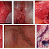 Obat kutil kelamin pada perempuan thumbnail