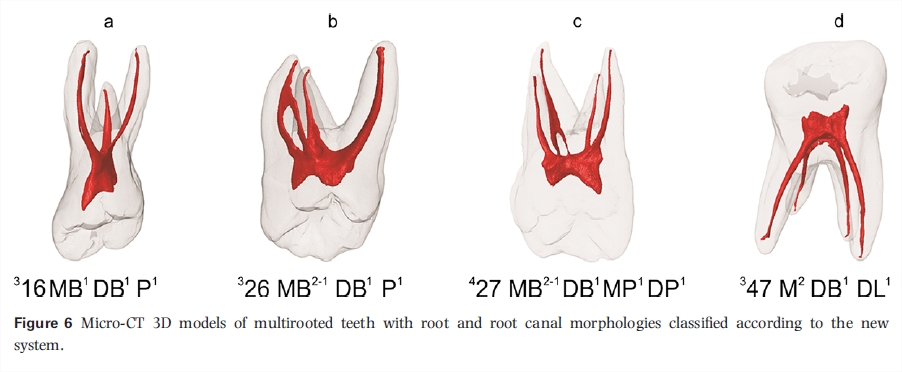 molar root canals