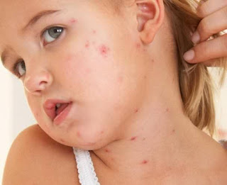 Khasre ki bimari Khasre ki bimari ko door karne ke gharelu nuskhe aur upay. Home Remedies for Measles in Hindi/Urdu.