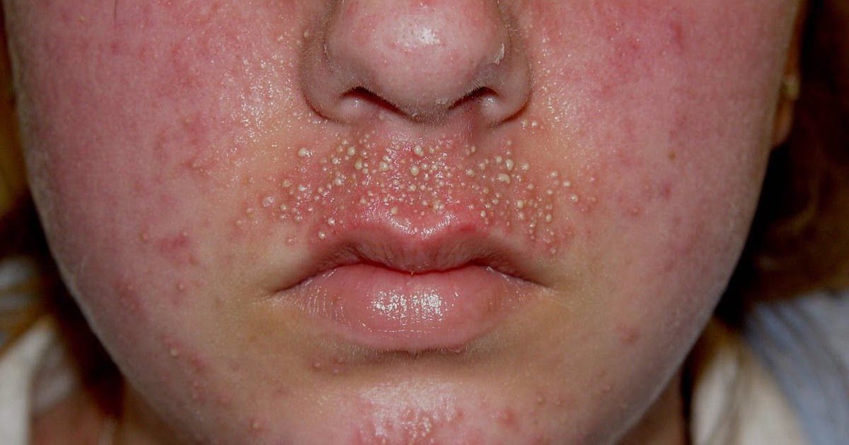 HOW TO CURE STAPHYLOCOCCUS AUREUS NATURALLY AT HOME