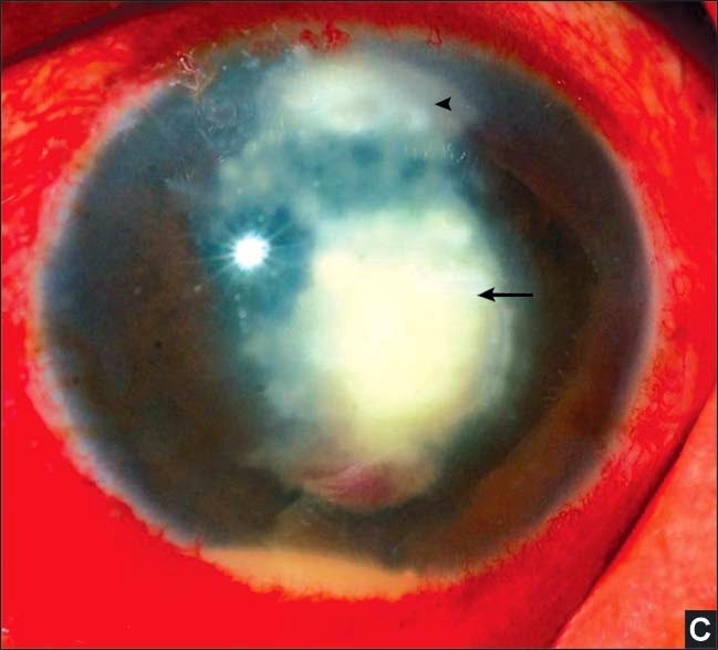 Clinical Presentation of Fungal Keratitis Tuyenlab