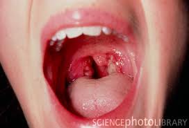One Side Of Throat Swollen 33