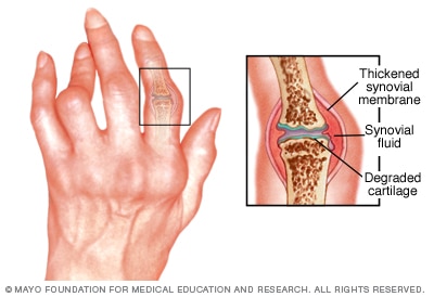 rheumatoid arthritis là bệnh gì cum tratează un osteopat artroza