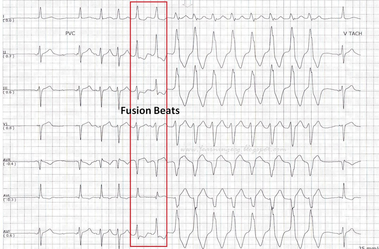 ecg-rhythms-fusion-beats