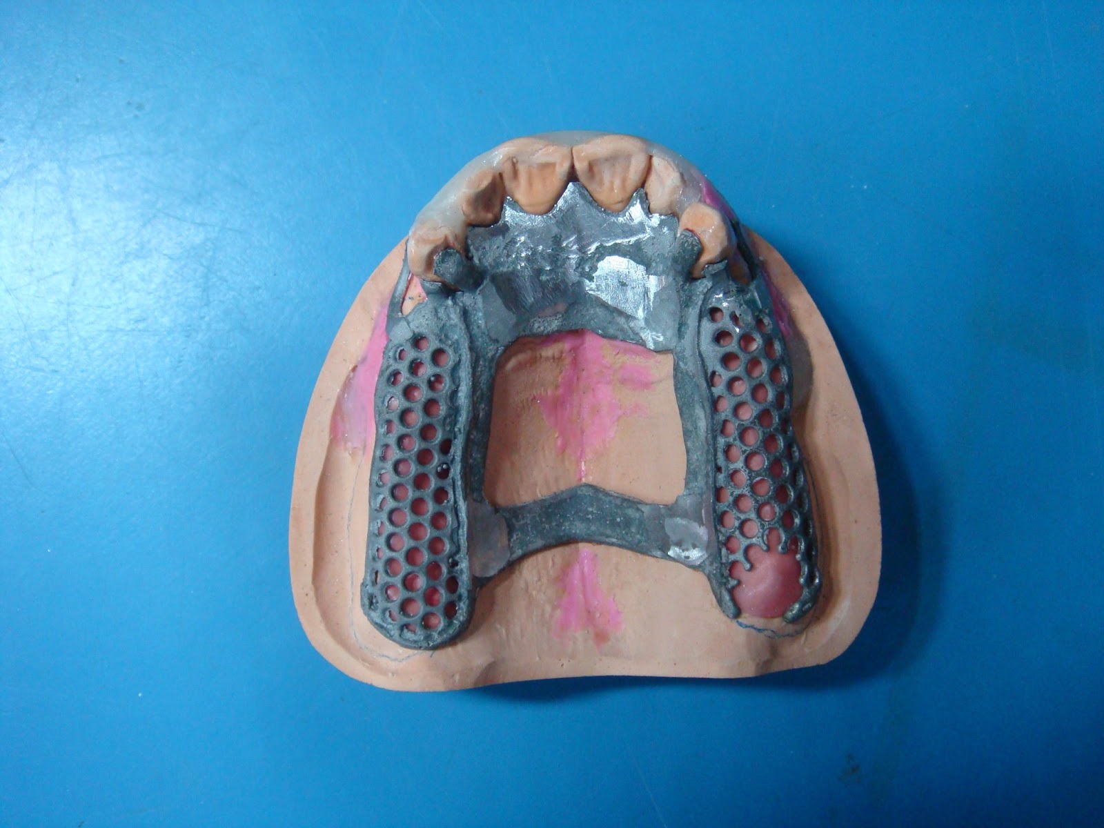 Understanding Prosthodontics Tagore Dental College & HospitalBy Department of Prosthodontics