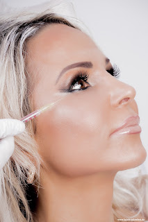 Botox bei mimischen Falten, wie den Krähenfüßen - LAJOLI Praxis