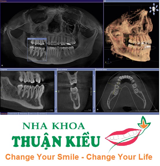 cay-ghep-rang-implant-nha-khoa-thuan-kieu-phan-mem-cay-implant-2015