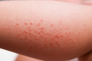 A mild rash caused by exposure to the sun pictures