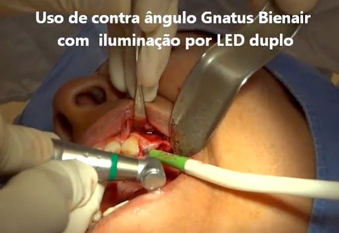 SINUS LIFT: Implante e regeneração óssea guiada - Motor Gnatus Bienair